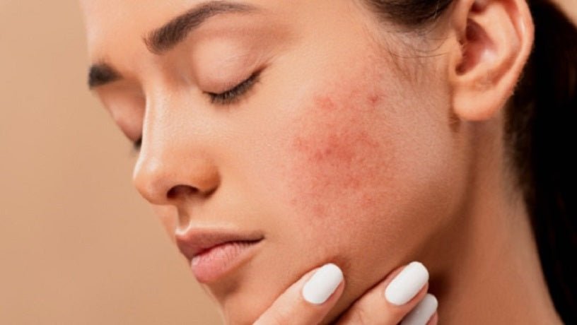 What is dehydrated skin and how to fix it - Skinyoga