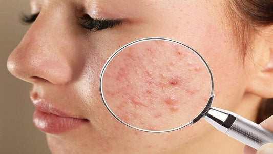 common skin problems - Skinyoga
