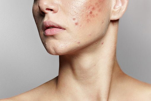 Acne Treatment: Naturally without Chemicals - Skinyoga