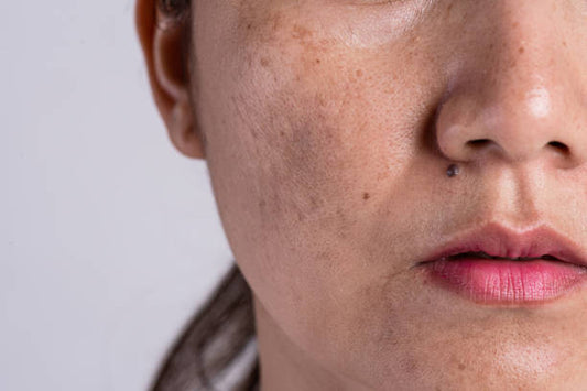 Pigmentation: Understanding the Causes and Treatment Options - Skinyoga