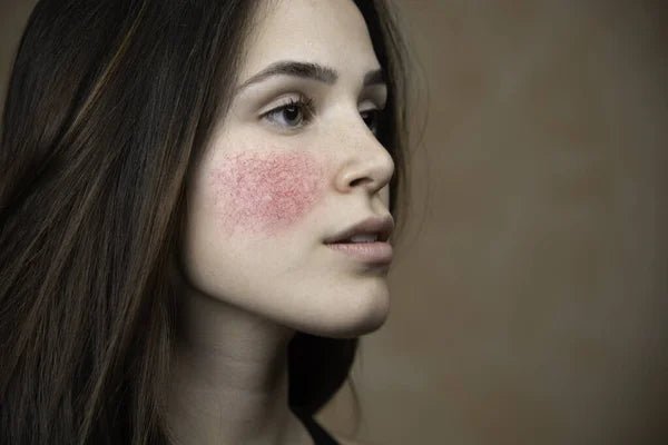 Rosacea treatment: Ayurveda Way - Skinyoga