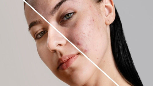 Ultimate Guide to Acne Treatment Effective Solutions for Clear Skin - Skinyoga